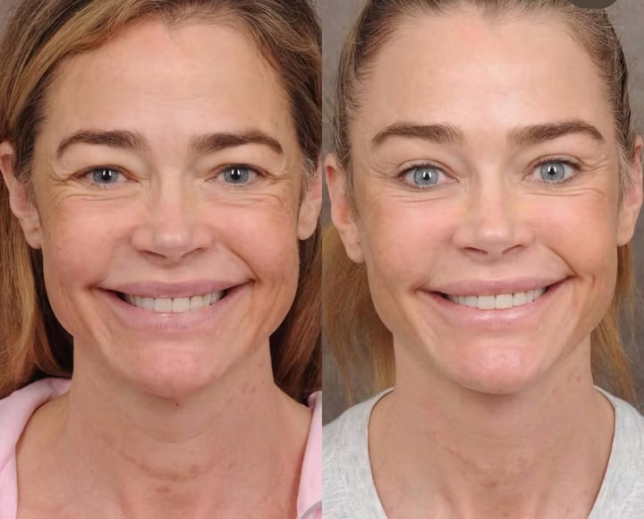 Результат пластичної операції Деніз Річардс підтяжка обличчя